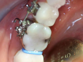 separators spacers orthodontic teeth mouth bands orthodontics band orthodontist terms rubber puresmile between sep springs dentistry tiny