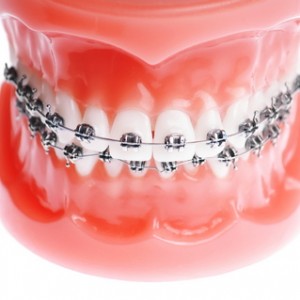 Transfer to a New Orthodontist, Braces, PureSmile
