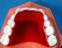 Orthodontic Terms, Biteplate, PureSmile, Shanghai