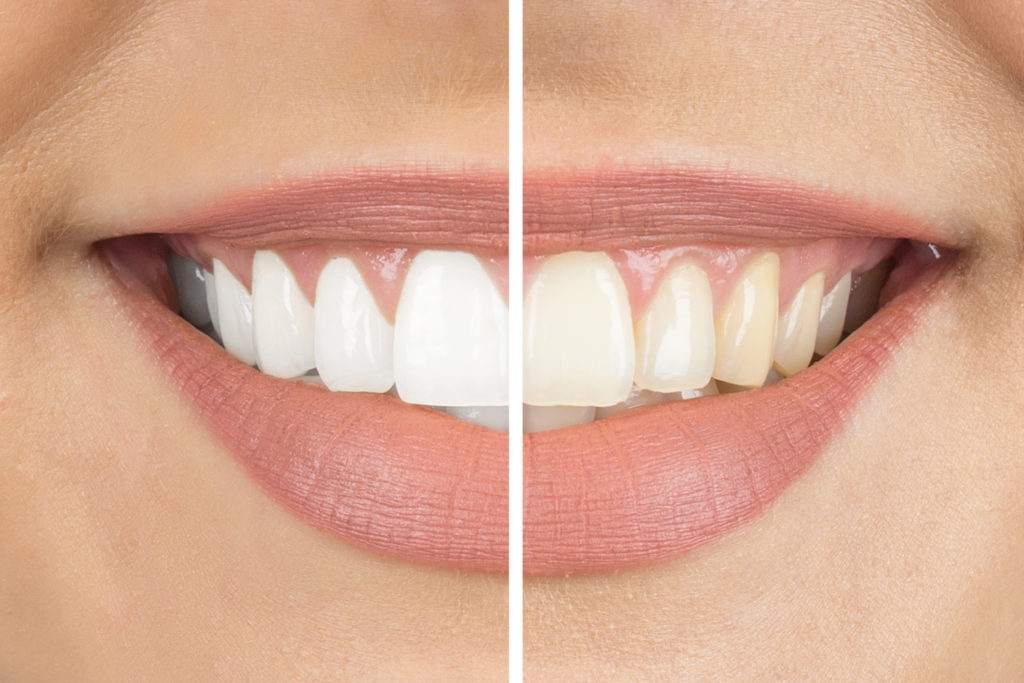 Teeth whitening in shangai before and after sample