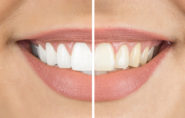 Teeth whitening in shangai before and after sample